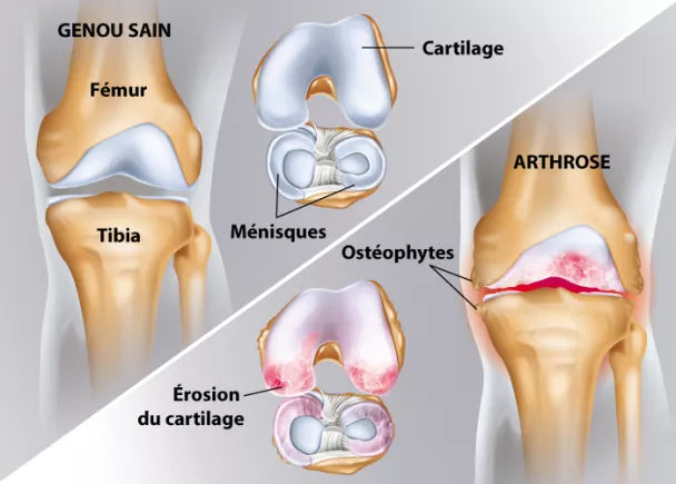 Arthrose du genou : comprendre, prévenir et soulager la douleur